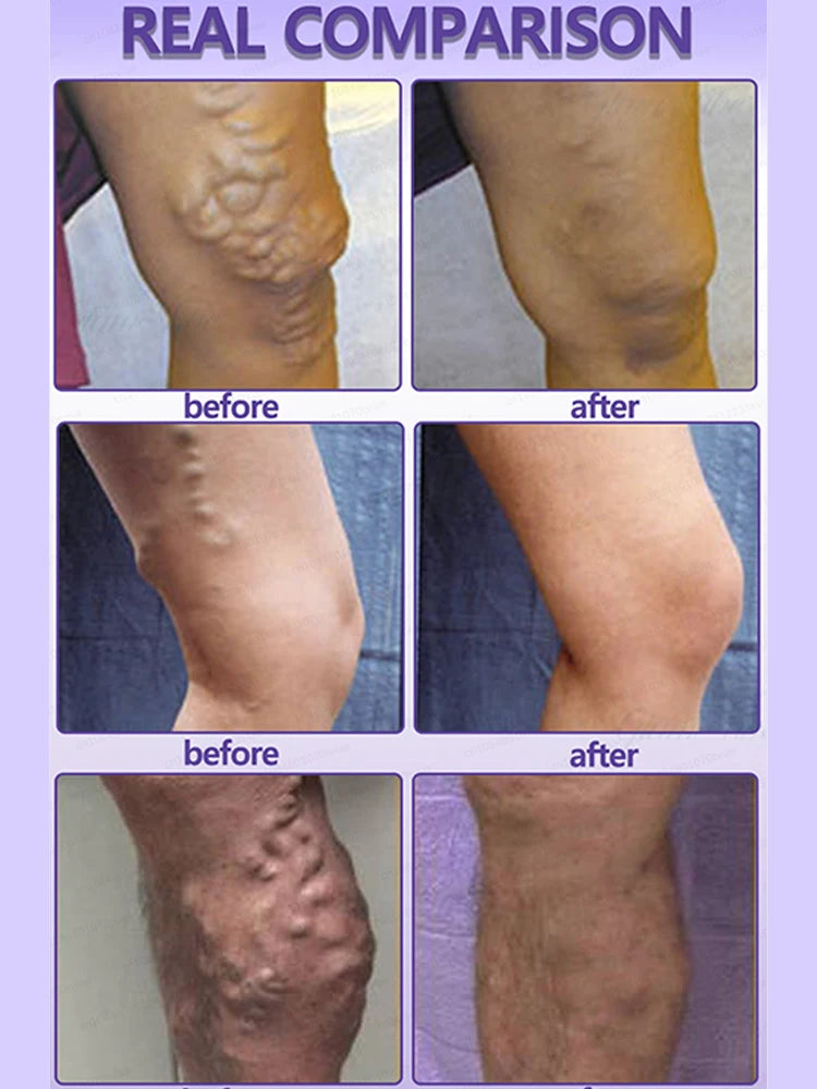 The days without varicose veins, the legs are very light