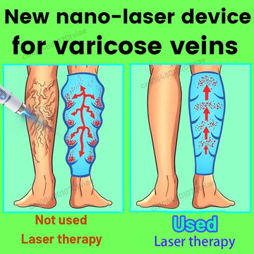 The days without varicose veins, the legs are very light